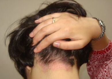 Psoriasia buruan