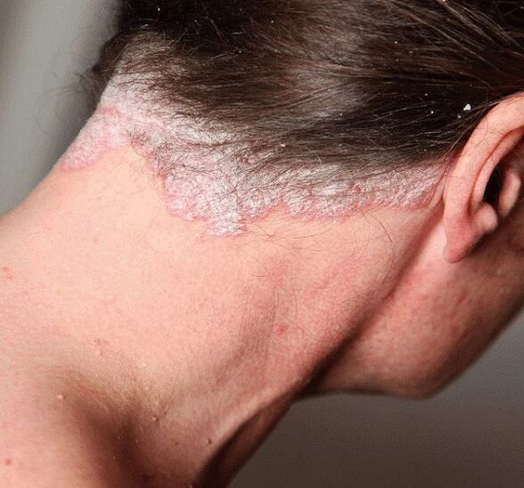 Psoriasia nola tratatu