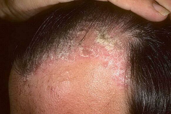 Psoriasia sintomak