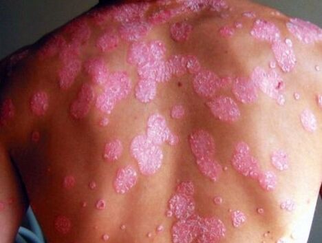 Gaixotasun psoriatikoa