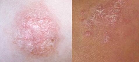 Psoriasia hasierako fasean