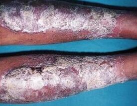 Psoriasia pomada